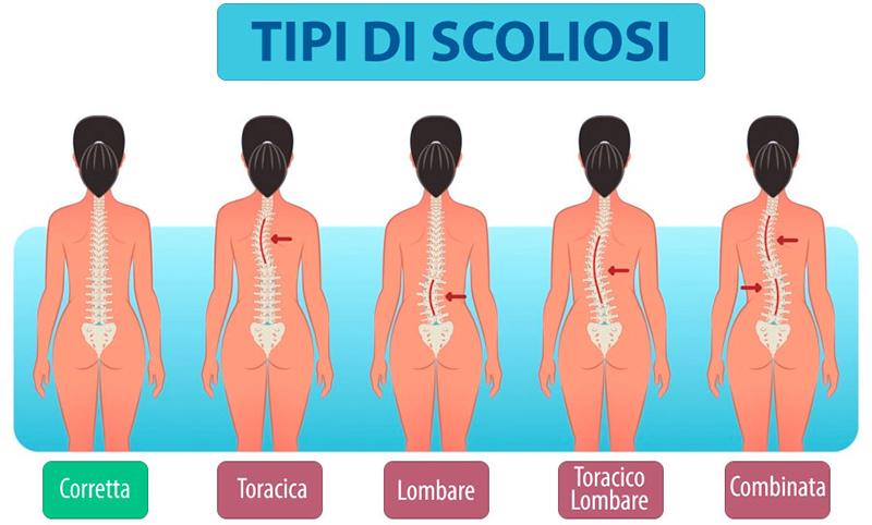 Mal di schiena (Low Back Pain): l'origine è spesso idiopatica - Centro  Fisioterapia Roma